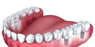 Avantages de la prothèse dentaire fixe de zirconium