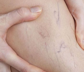 3 questions clés concernant la chirurgie des varices