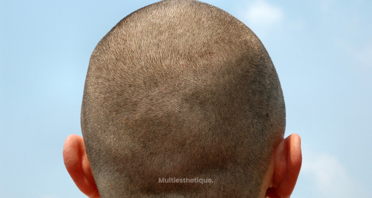 A Quoi Sert Le Platre Apres Rhinoplastie Tout ce que vous devez savoir sur la micropigmentation capillaire
