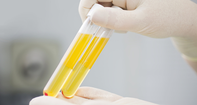 Implants de PRP : quels sont leurs avantages ?