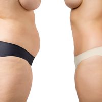 Tout savoir sur la cryolipolyse Tout savoir sur la cryolipolyse