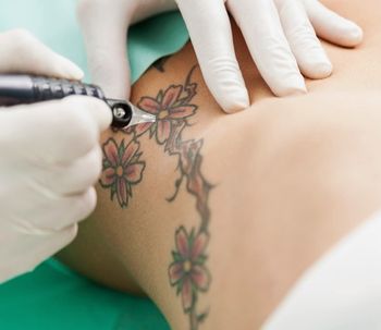 Éliminer ses tatouages sans laser avec Skinial