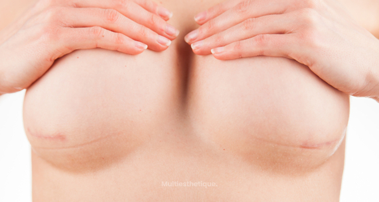 Types de cicatrices et soins après une chirurgie d’augmentation mammaire