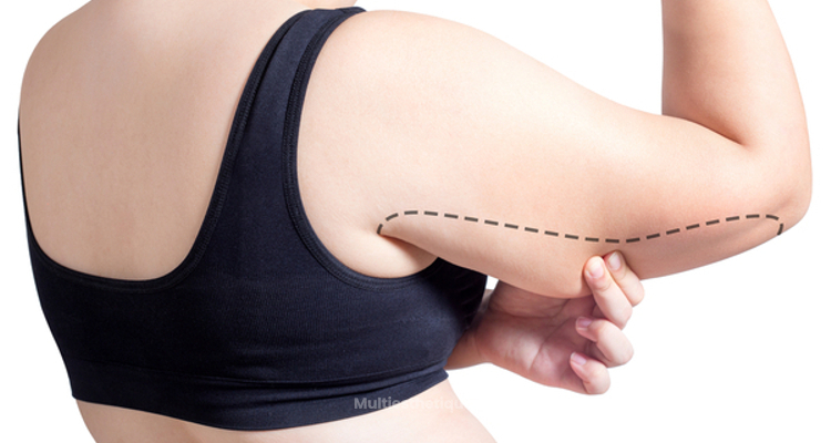 La liposuccion des bras est-elle aussi efficace que la brachioplastie ?