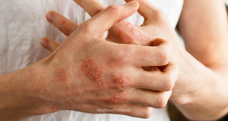 Quels sont les différents types de dermatite et comment les soigner ?