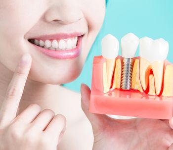 Implants dentaires à mise en charge immédiate