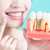 Implants dentaires à mise en charge immédiate