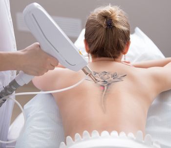 Tout ce que vous devez savoir pour vous débarrasser de votre tatouage
