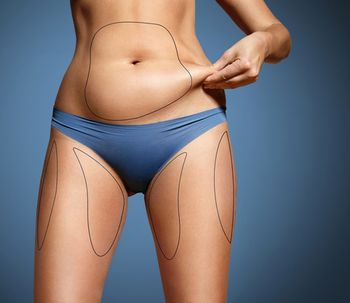 Comment éviter la reprise de poids après une liposuccion ?