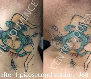 Détatouage laser
