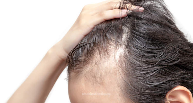 La mésothérapie pour lutter contre la chute des cheveux