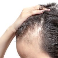 La mésothérapie pour lutter contre la chute des cheveux