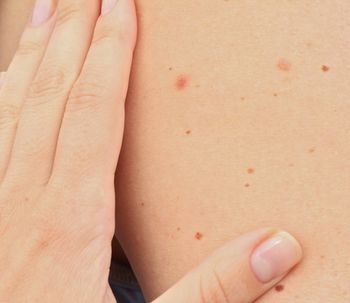Comment enlever un grain de beauté sans laisser de cicatrice ?