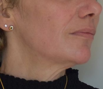 Peelings profonds et liftings médicaux