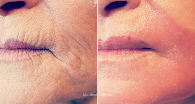 Tout savoir sur le peeling profond