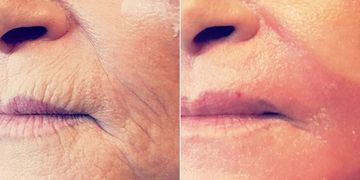 Tout savoir sur le peeling profond