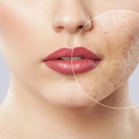 Comment éliminer ses cicatrices d’acné ? 