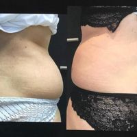 Dr Marie Levisse répond à toutes nos questions sur la cryolipolyse