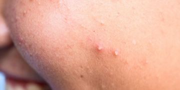Les différentes solutions du Dr Charlot contre l'acné