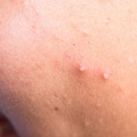 Les différentes solutions du Dr Charlot contre l'acné