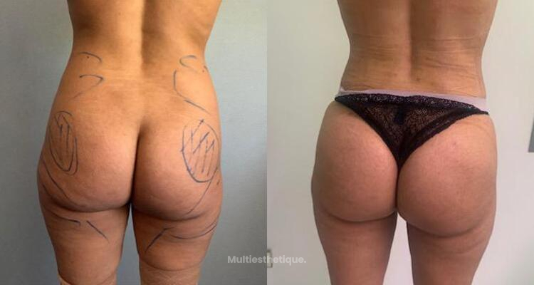 Deux solutions pour augmenter le volume de ses fesses