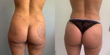 Deux solutions pour augmenter le volume de ses fesses Deux solutions pour augmenter le volume de ses fesses