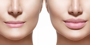 Le traitement des lèvres par injection d'acide hyaluronique Le traitement des lèvres par injection d'acide hyaluronique