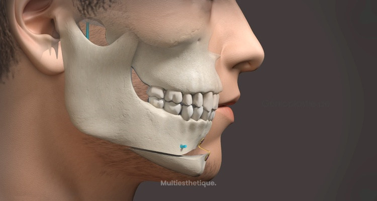 Interactions entre rhinoplasties (chirurgie du nez) et ostéotomies (chirurgie des mâchoires)