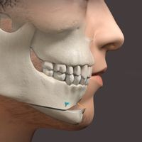 Interactions entre rhinoplasties (chirurgie du nez) et ostéotomies (chirurgie des mâchoires)