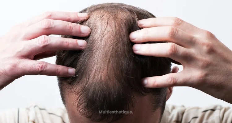 La perte de cheveux décrite par le Dr Alain Berkovits