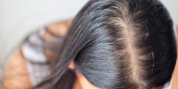 Que faire après une chute de cheveux postnatale ?