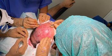L'optimisation de l’implantation capillaire par technique robotique L'optimisation de l’implantation capillaire par technique robotique
