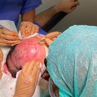 L'optimisation de l’implantation capillaire par technique robotique