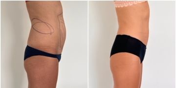 Entretien avec le Dr Bertrand Delaoustre sur la liposuccion médicale Entretien avec le Dr Bertrand Delaoustre sur la liposuccion médicale