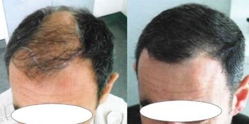 Les spécificités des cheveux crépus expliquées par le Dr Alain Berkovits