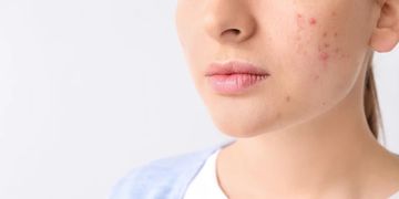 Guide complet sur l’acné les tâches pigmentaires et impuretés de la peau: causes et traitements