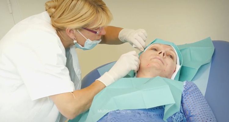 Fils tenseurs résorbables : Une option populaire pour le rajeunissement du visage sans chirurgie