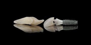 Implant Dentaire Céramique Zircone : Esthétique et Durabilité Réunies pour des Sourires Radieux
