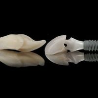 Implant Dentaire Céramique Zircone : Esthétique et Durabilité Réunies pour des Sourires Radieux