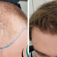 Traitements et résolutions efficaces grâce à la Greffe de Cheveux FUE