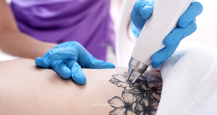 Le détatouage au laser : comment enlever un tatouage ?
