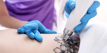Le détatouage au laser : comment enlever un tatouage ?