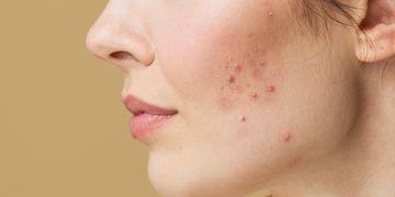 Tout savoir sur l’acné
