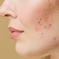 Tout savoir sur l’acné