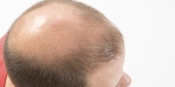Greffe de cheveux : comment se préparer et quels sont les soins à prodiguer ?