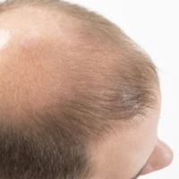 Greffe de cheveux : comment se préparer et quels sont les soins à prodiguer ?