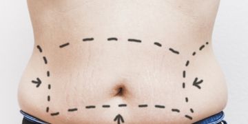 Les traitements possibles pour perdre de la graisse externe au niveau de l’abdomen