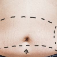 Les traitements possibles pour perdre de la graisse externe au niveau de l’abdomen