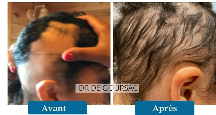La chute des cheveux à deux vitesses : Carboxythérapie et casque LEDs vs Facteurs de croissance et casque LEDs