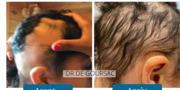 La chute des cheveux à deux vitesses : Carboxythérapie et casque LEDs vs Facteurs de croissance et casque LEDs